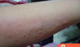 治疗慢性荨麻疹的药